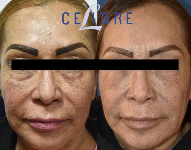 Sculptra can restore volume to the cheeks, providing a more youthful and lifted appearance.