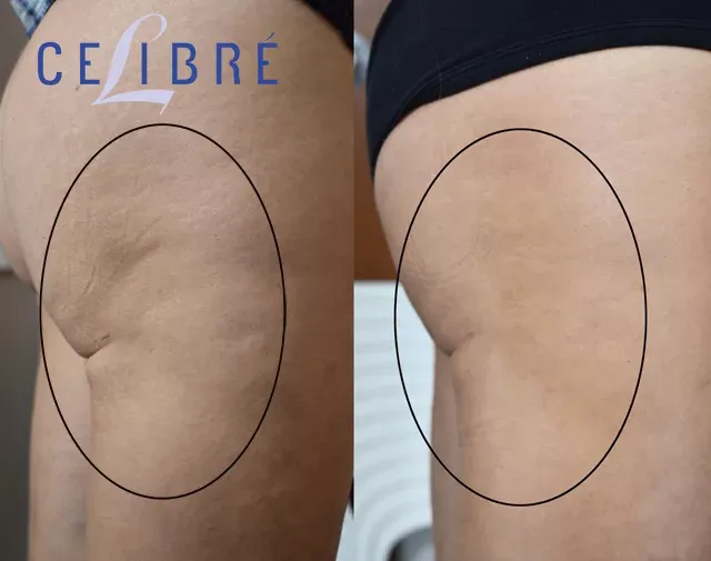 Sculptra is an effective treatment for hip dips, providing a smoother and more contoured silhouette.