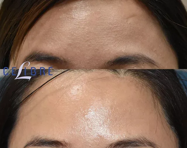 Smooth and refresh your look with Dysport-injections-for-forehead-wrinkles results