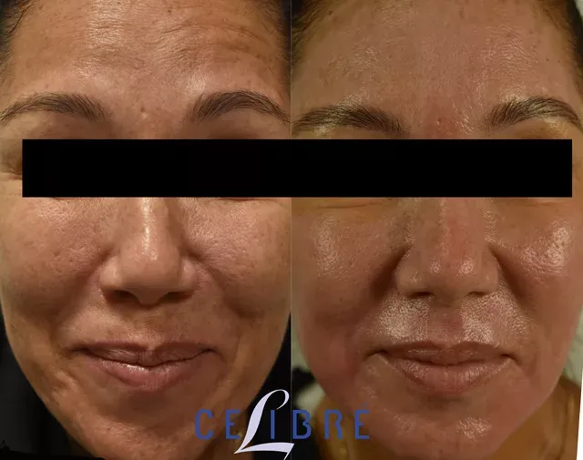 Refine skin texture with remove-large-pores-with-CO2-laser-resurfacing results