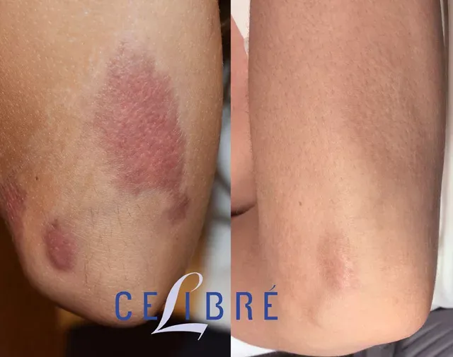 Significant improvement in Red Scar Removal with Vbeam laser, as shown in these before and after pictures.