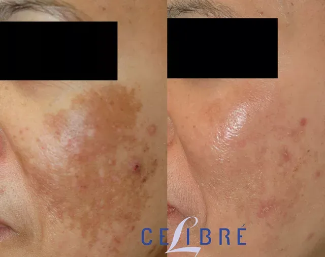 Asian-skin-Melasma-treatment-before-and-after