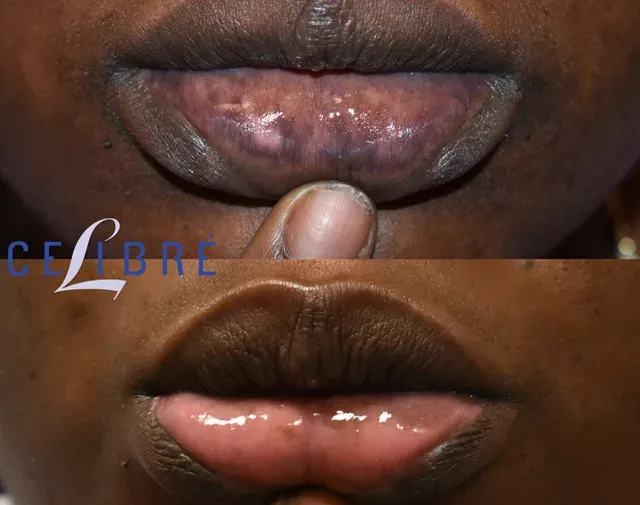 Brighten your smile with African-American-lip-spot-removal results