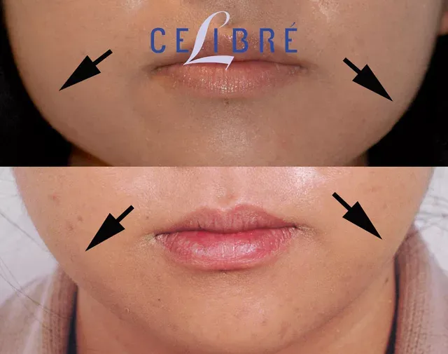 Achieve a slimmer look with asian-jaw-slimming-with-botox-before-after results