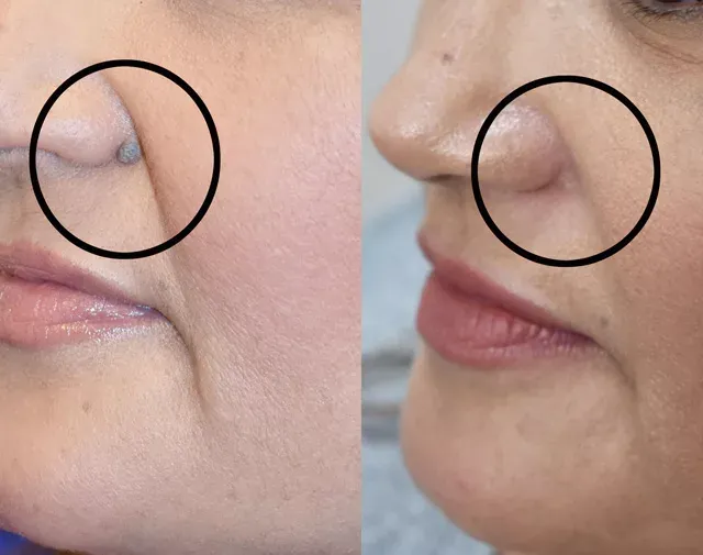 Big-mole-removal-after-laser shows smooth, clear skin with safe and effective treatment results.