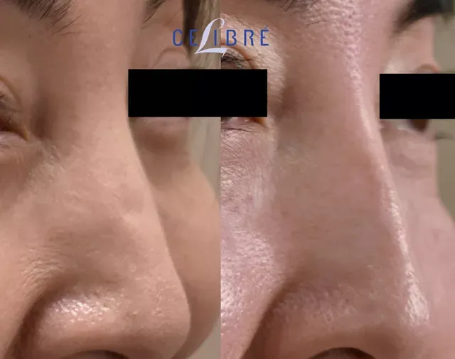 non-surgical-rhinoplasty-before-after