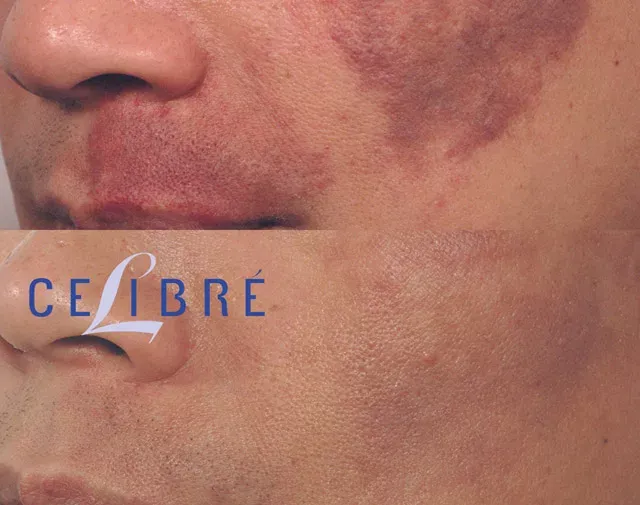 Effective wine-stain-birthmark-removal-laser treatment offers clearer, smoother skin with lasting results