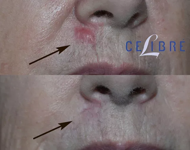 Remarkable improvement in Keloid scar removal with steroid injections, as seen in this before and after comparison.