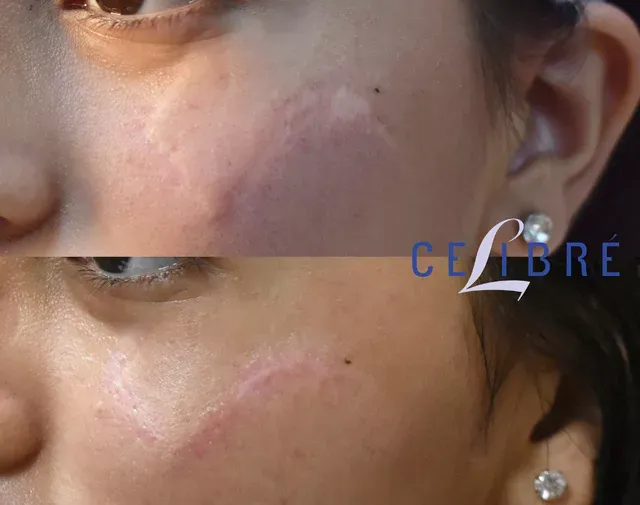 Significant improvement in facial scar removal with laser and steroid injections, shown in this before and after comparison.