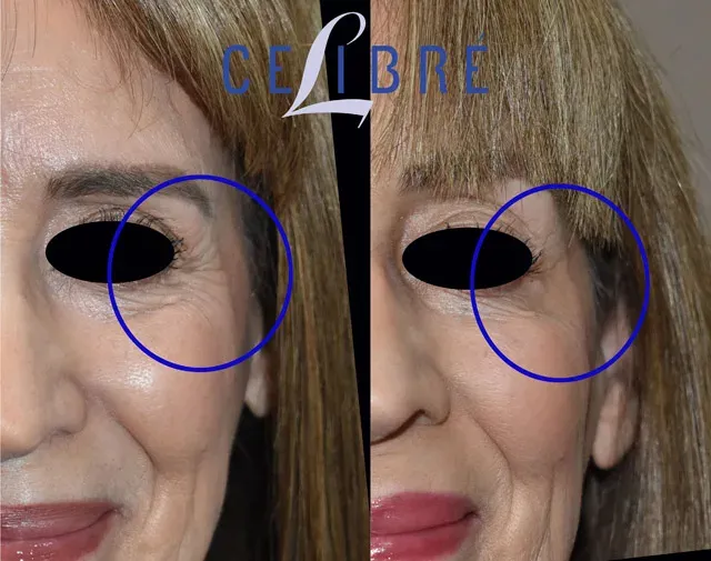 Significant improvement in Crow\'s Feet with Dysport, as shown in this before and after comparison.