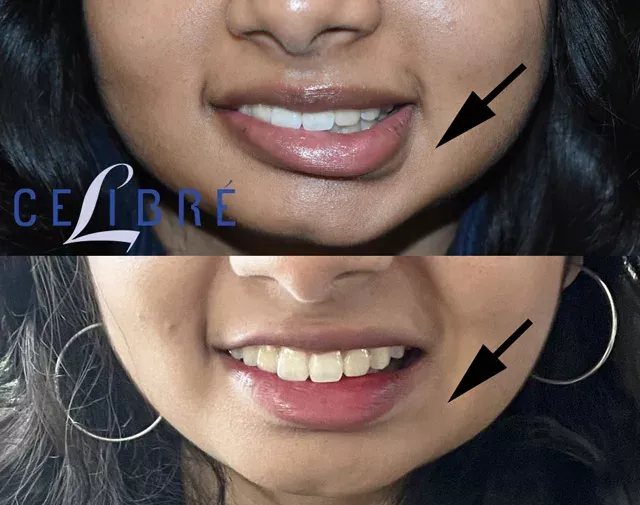 Significant improvement in a crooked smile with Botox injections, as seen in this before and after comparison.