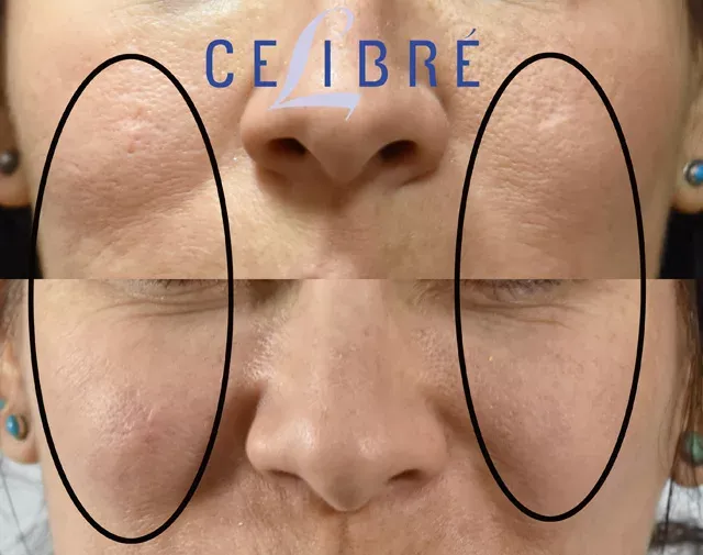 Remarkable improvement in acne scars with fractional laser resurfacing, as shown in these before and after photos.