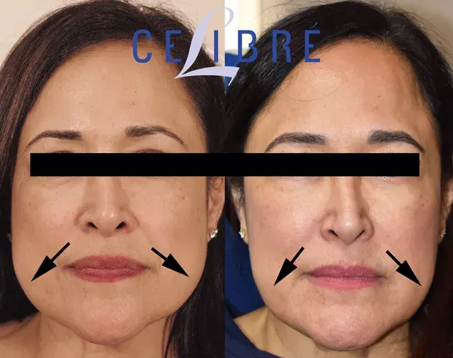 Significant improvement in jaw shaping with Dysport injections, as seen in this before and after comparison.