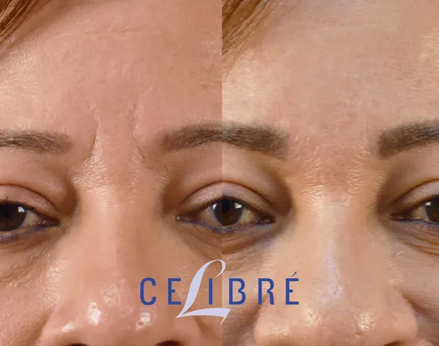 Significant improvement in deep frown lines with Dysport and filler, as seen in this before and after comparison.