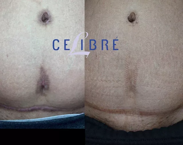 Significant improvement in Mommy Makeover Scar Revision, as shown in these before and after photos.