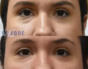 hispanic dark circles under eyes restylane before after