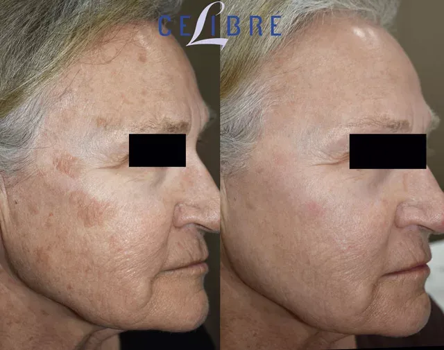 The Palomar laser effectively removes age spots, as seen in these before and after photos.