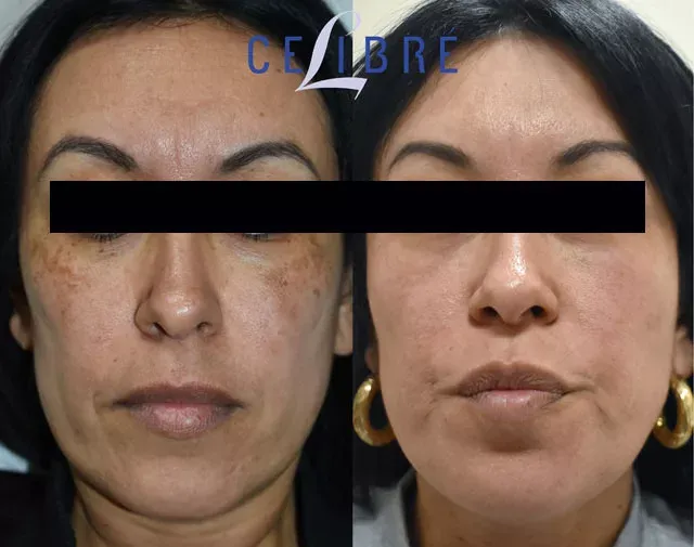 Witness the before-and-after of laser treatment for age spots on Hispanic skin, revealing a clearer complexion.