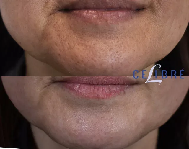 Restore smooth, clear skin with Acne-Scar-laser-resurfacing-near-me for lasting confidence