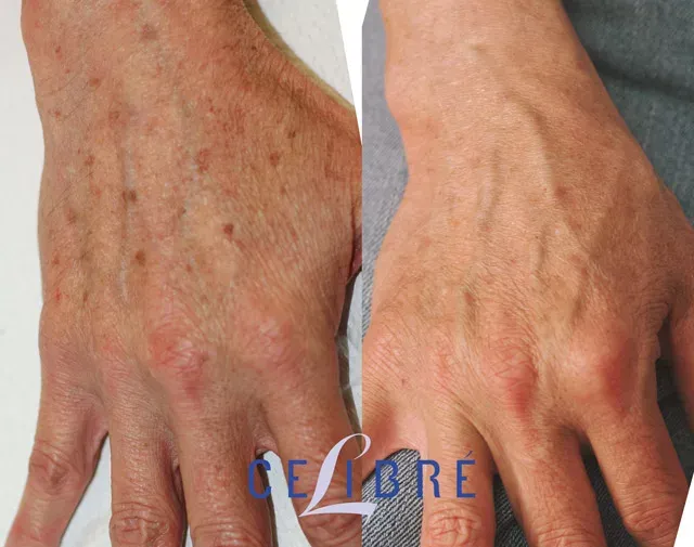 Asian-skin-Hand-brown-spot-removal-with-lasers