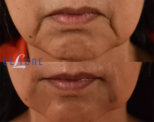 Smooth and define your profile with Radiesse-for-chin-lines-before-after results