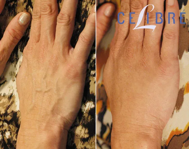 Restylane-Lyft-injections-for-hand-rejuvenation-before-after show fuller, smoother hands with a youthful appearance.