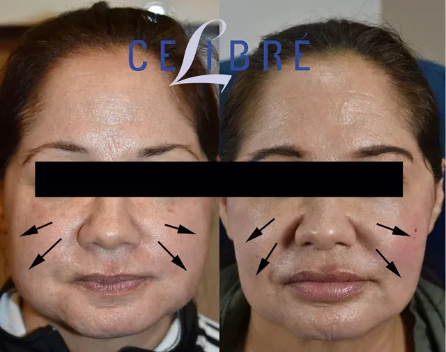 Find relief and balance with botox-for-migraines-jaw-clenching-before-after results