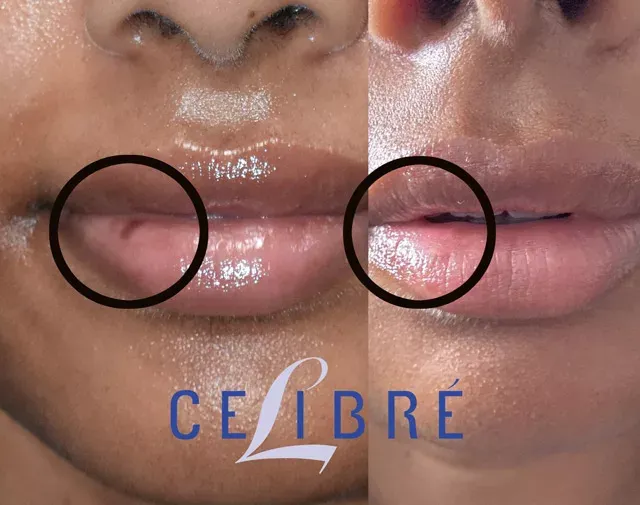Reveal smoother, even-toned lips with laser-lip-spot-removal-before-and-after results