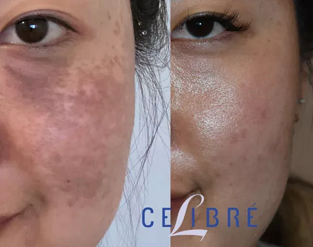 Laser-removal-of-nevus-of-ota-birthmark-asian-skin-before-after-photos show significant lightening and smoother, even skin tone.