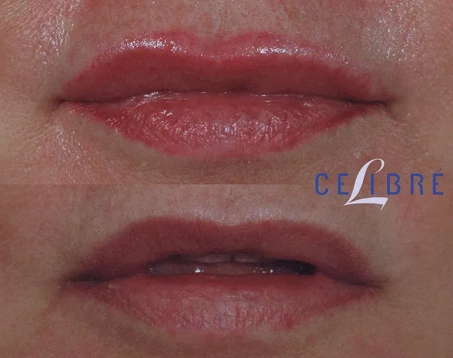 Lip-makeup-removal-laser-before-and-after shows clear, natural lips with effective and precise laser results.