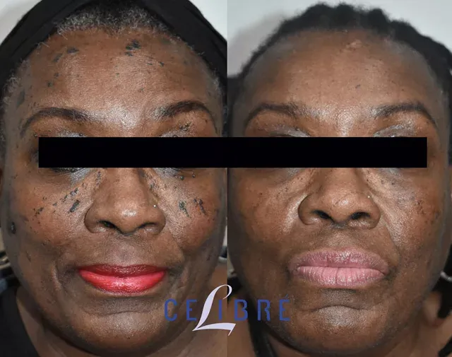 Mole-removal-black-skin-before-and-after shows clear, smooth skin with effective and safe removal results.