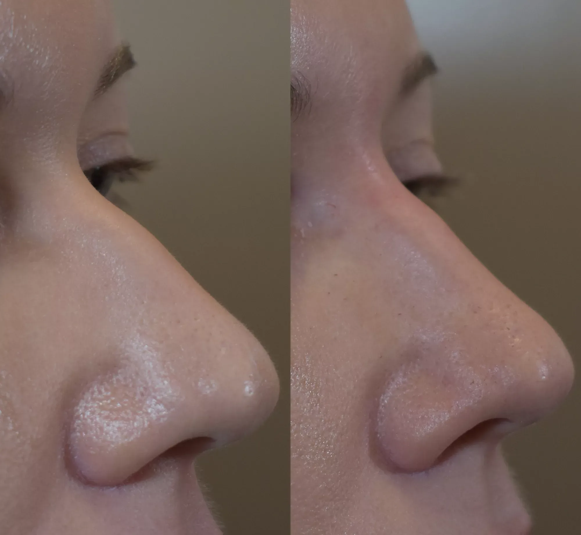 See the difference with non-surgical-rhinoplasty-before-after transformation results