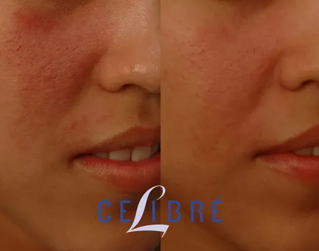 Wine-birthmark-removal-vbeam-laser treatment offers safe, effective results for clearer, smoother skin