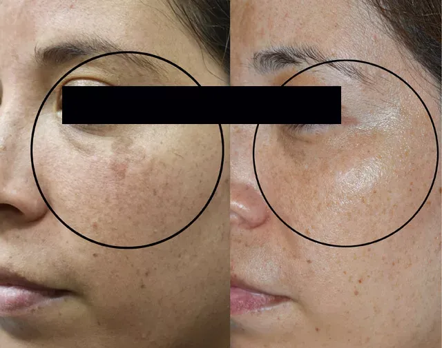 Witness the before-and-after of laser treatment for brown spots on Hispanic skin, revealing a clearer, more even-toned complexion.
