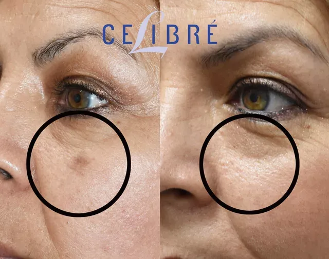 Witness the incredible before-and-after transformation of liver spots with laser treatment, revealing a clearer, more even skin tone.