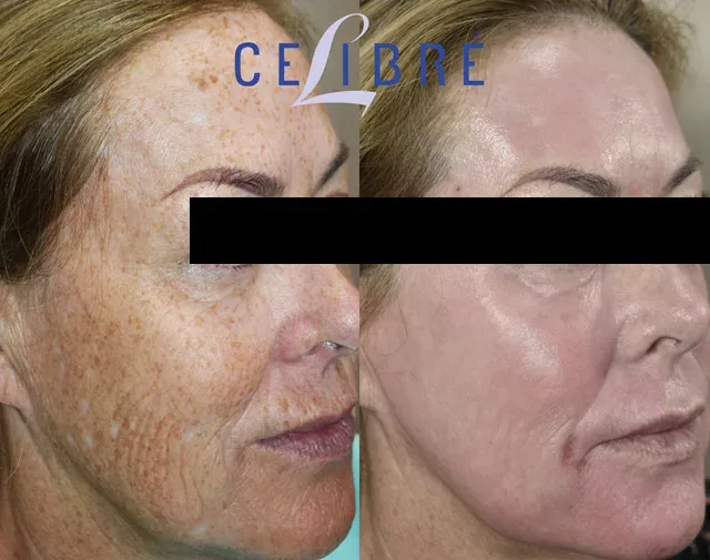 Laser resurfacing is an effective treatment to remove age spots and sun damage, revealing a clearer, more youthful complexion.