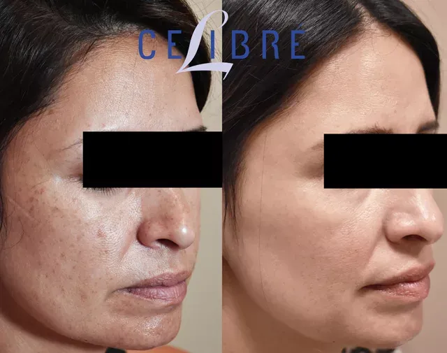 Witness the before-and-after of laser treatment for age spots on Hispanic skin, revealing a clearer, more even-toned complexion.