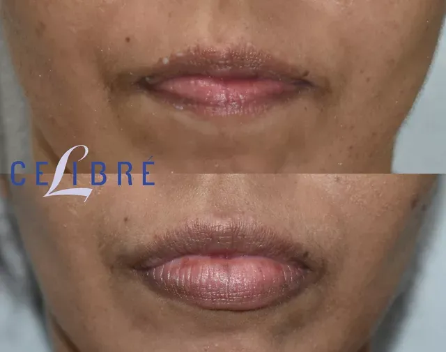 Restylane Kysse for lip filler before & after natural fullness with soft, defined lips