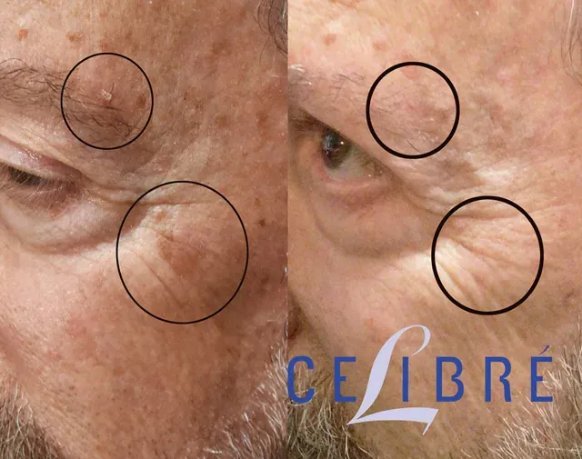 See the amazing before-and-after of laser removal for both skin tags and sun spots, revealing a clearer and smoother complexion.