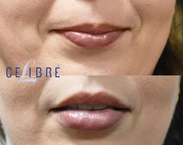 Full lips with Restylane Kysse before & after soft volume and natural definition