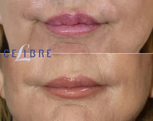 Lip correction with Restylane before & after smooth, balanced, and naturally enhanced lip