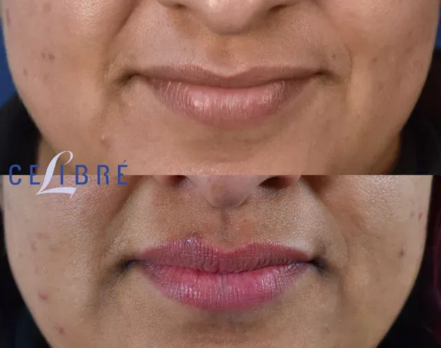 Lip flip before & after with Dysport subtle lift for a natural, youthful pout