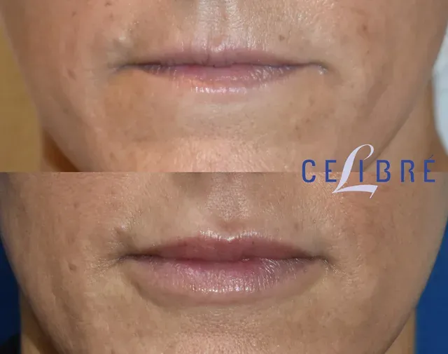 Restylane Kysse lips before after