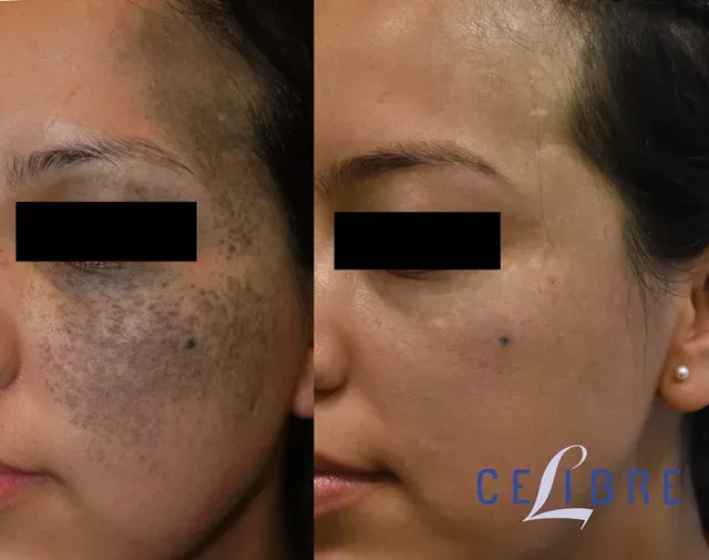 Laser-treatment-for-nevus-of-ota-before-after-pictures shows impressive lightening and smoother, more even-toned skin.