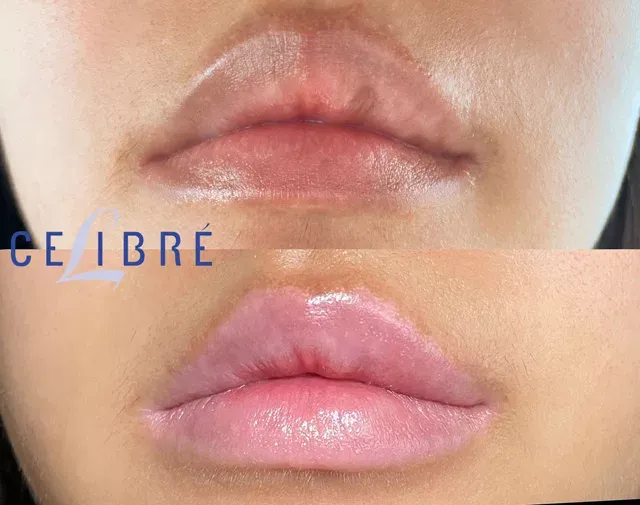 Dark-spots-on-lips-removal-before-after shows clearer, even-toned lips with noticeable spot reduction.
