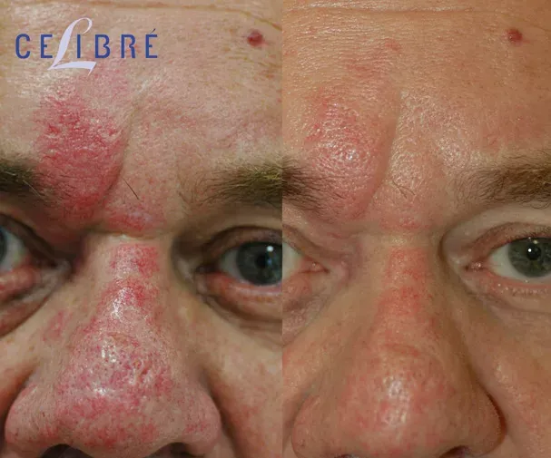 Facial-red-birthmark-removal-with-laser treatment helps reduce visible marks for smoother, clearer skin