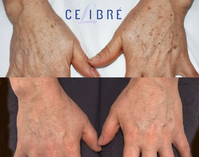 Hand-spot-removal-before-and-after-photos-laser shows youthful, clearer hands with visible spot reduction.