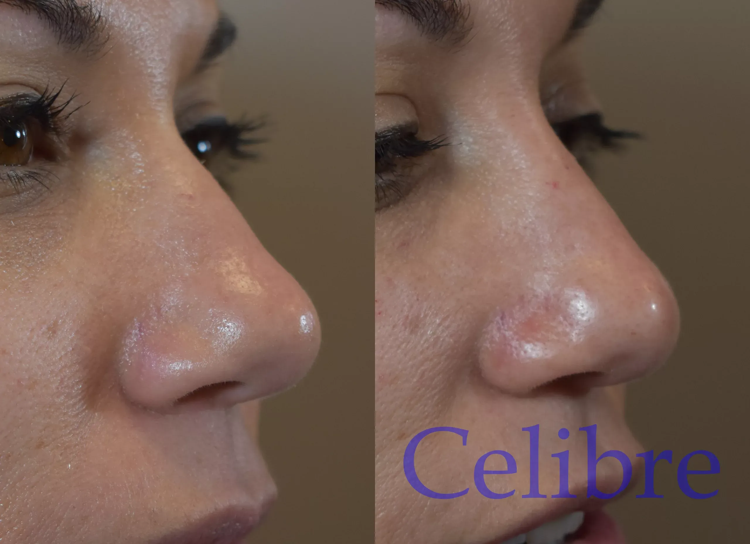 See stunning transformations with nose-filler-before-and-after-pictures-scaled for a natural, enhanced look