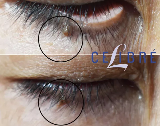 Skin-tag-mole-removal-on-eye-before-and-after shows smooth, clear skin with safe and precise removal results.