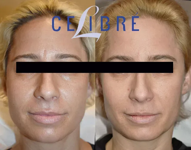 See a refined profile with thinner-jaw-with-botox-before-after transformation results
